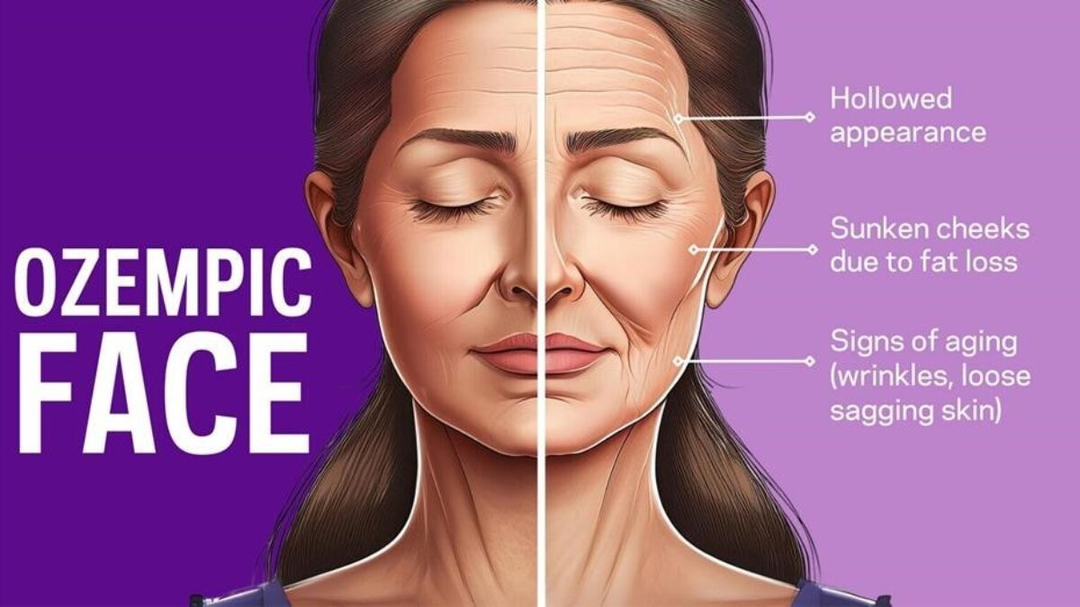 Understanding Ozempic Face