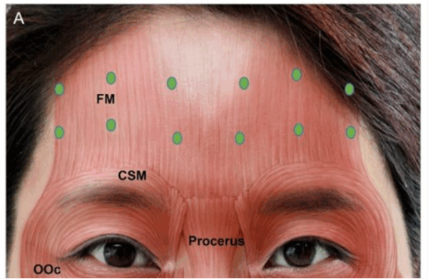 Forehead Botox for Lines | Bay Aesthetics Singapore