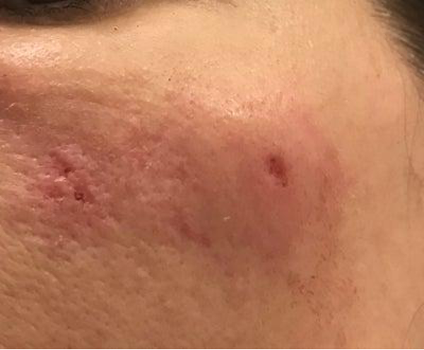 Facial burn