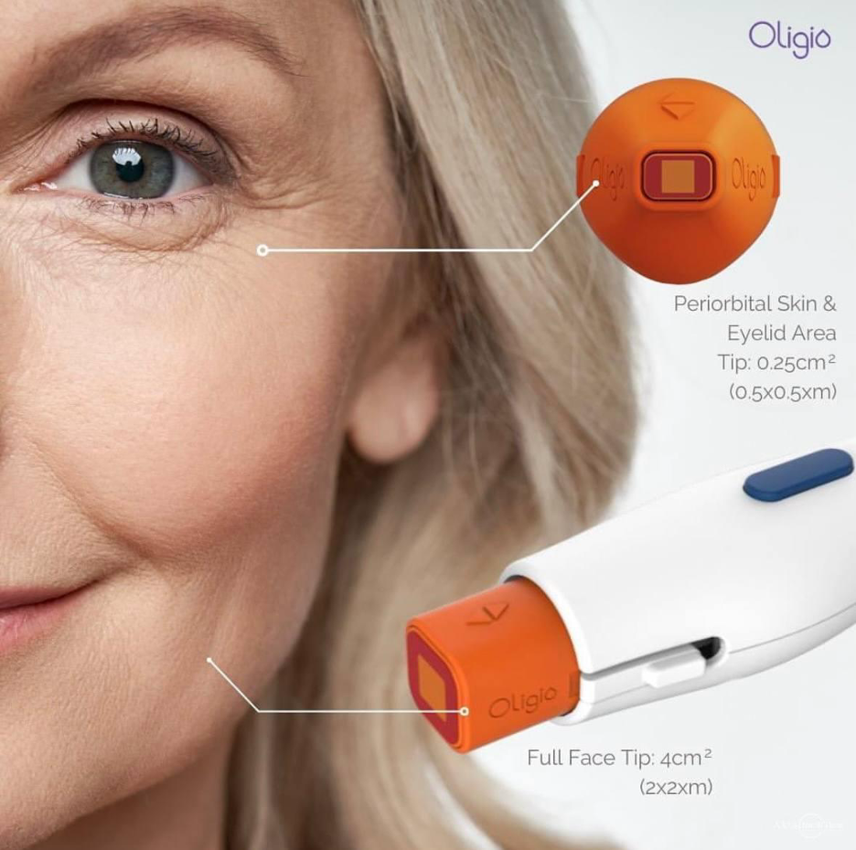 Oligio RF for face, neck and eyelid skin tightening