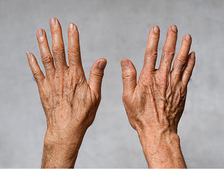 Aged hands with volume loss, prominent tendons and veins, as well as fine lines and pigmentation