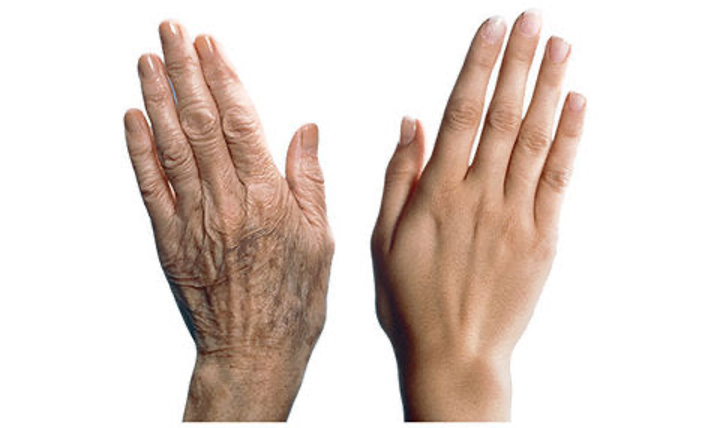Ageing of the hands- loss of volume, pigmentation and fine lines