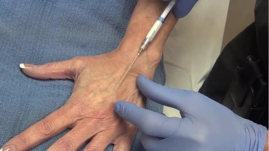Radiesse injections for hand rejuvenation at Bay Aesthetics Clinic