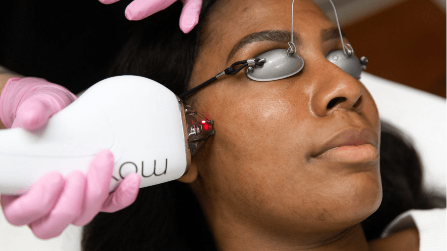 MOXI Laser is safe and effective for darker skin types
