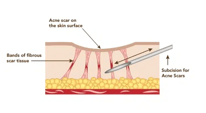 Subcision for acne scars Singapore