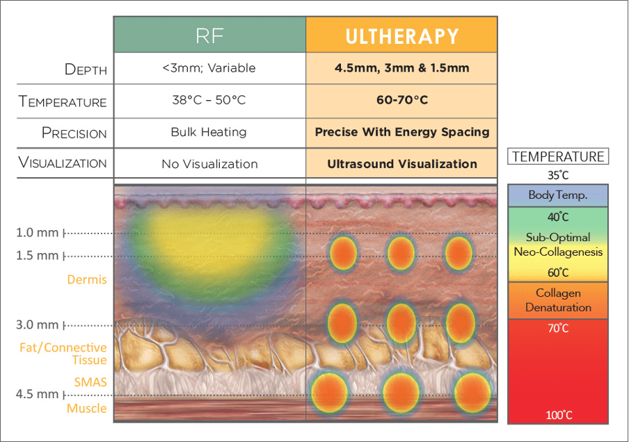 Ultherapy and Oligio RF treatments are safe for skin tightening in darker skin types