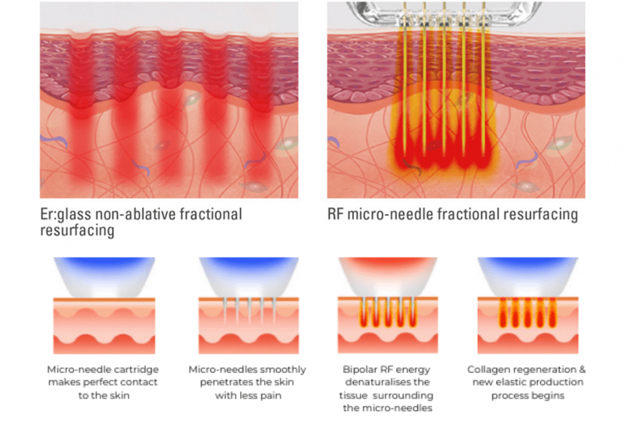 SecretDUO- RF microneedling and Fractional laser (non-ablative)