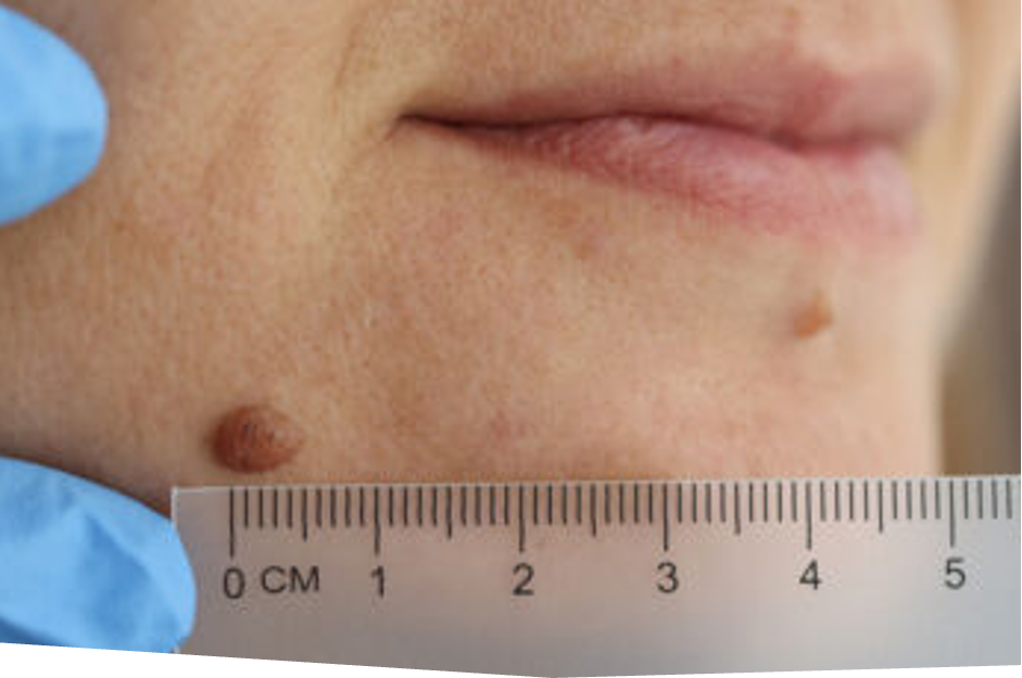 Mole removal Singapore