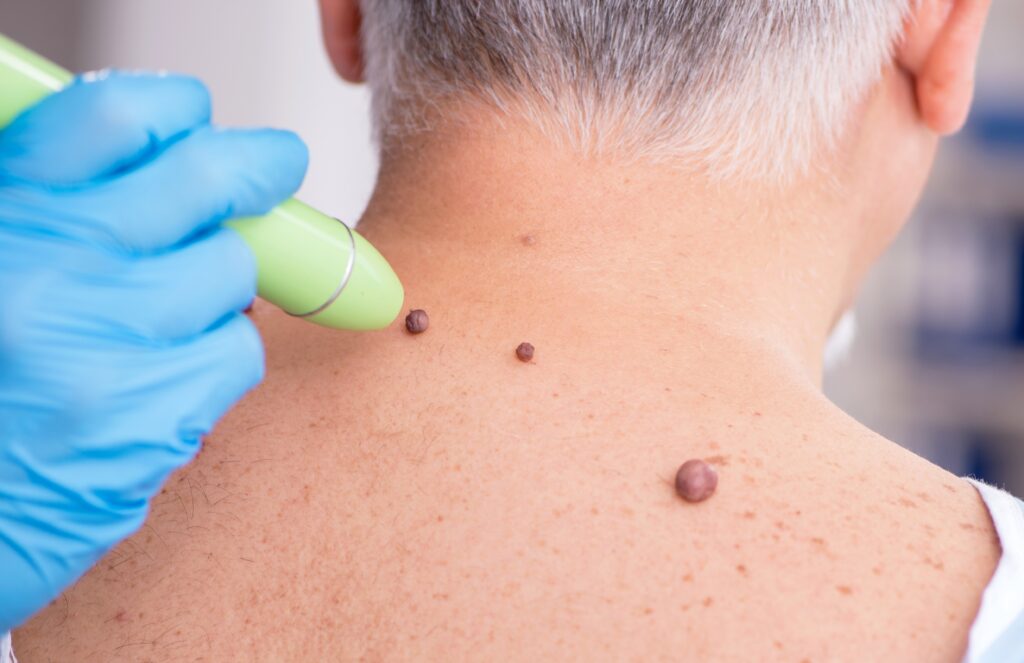 Doctor performing skin tag removal on the back of an older man using a handheld device, a common procedure similar to mole removal