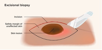 Surgical mole removal Singapore