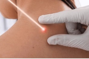 Laser mole removal Singapore